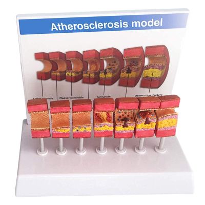 DYTAH Human Artery Anatomy Model with Atherosclerosis and Thrombus