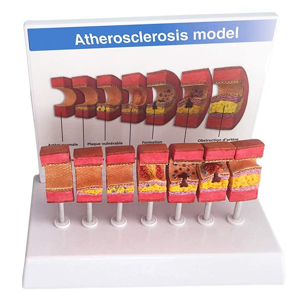 DYTAH Human Artery Anatomy Model with Atherosclerosis and Thrombus