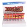 DYTAH Human Artery Anatomy Model with Atherosclerosis and Thrombus view 1