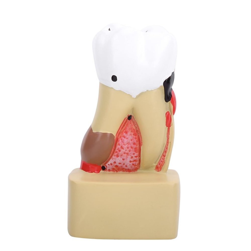WlP Dental Caries Model, Comprehensive Dental Pathology Model for School Study
