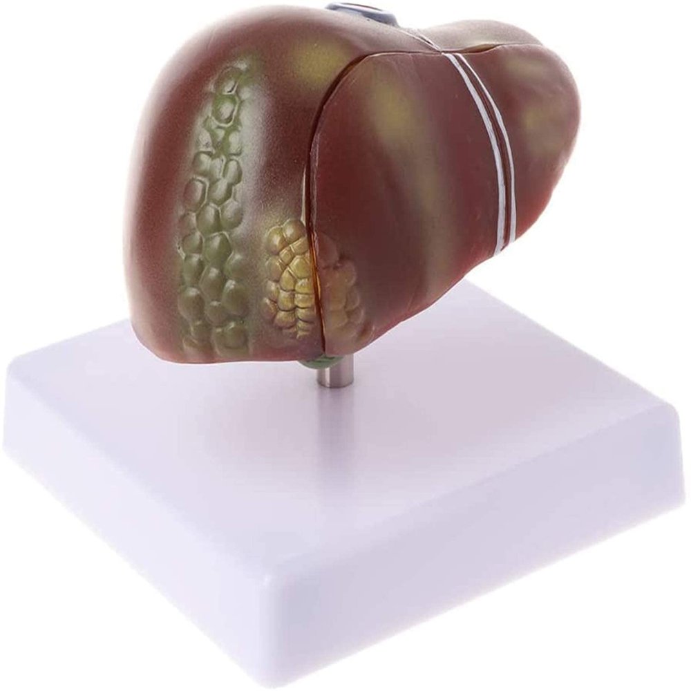 Pathological Anatomical Model of the Human Liver