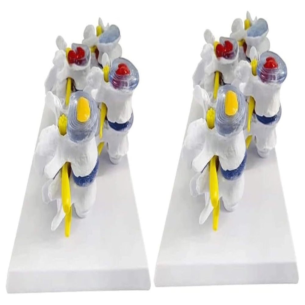 Human Anatomy Model, Skeletal Pathology and Lumbar Disc Model, 1:1 Scale
