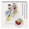 Human Anatomy Model, Skeletal Pathology and Lumbar Disc Model, 1:1 Scale view 4