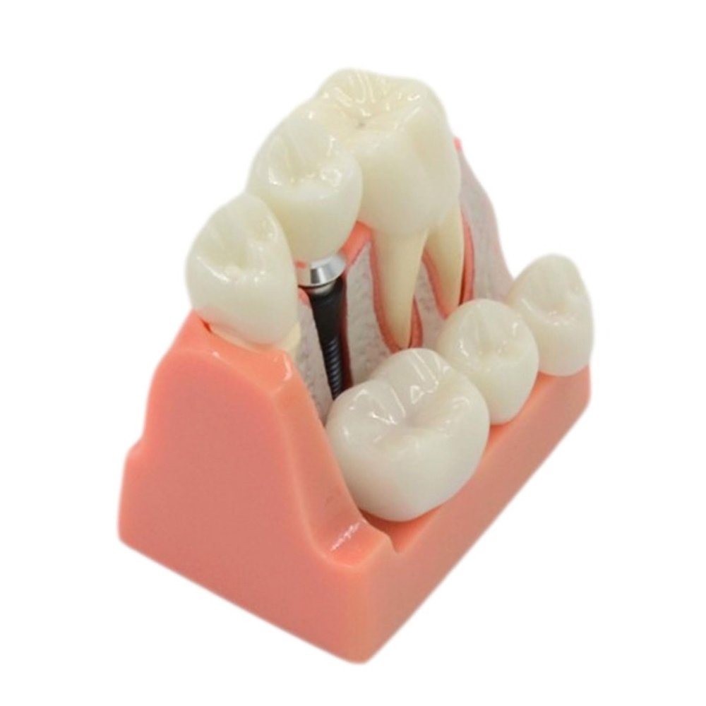Implant Analysis Bridge, Removable Demonstration Dental Model for Dentist-Patient Communication, Patient Education, Students, and Teaching/Research