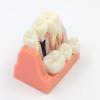 Implant Analysis Bridge, Removable Demonstration Dental Model for Dentist-Patient Communication, Patient Education, Students, and Teaching/Research view 4