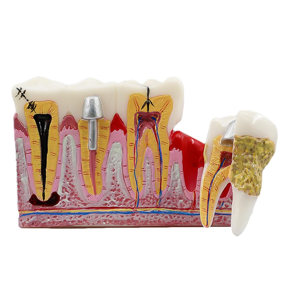 JYBNBBE Anatomical Tooth Decay Model for Anatomy and Physiology Education