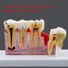 JYBNBBE Anatomical Tooth Decay Model for Anatomy and Physiology Education view 2