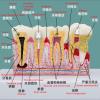 JYBNBBE Anatomical Tooth Decay Model for Anatomy and Physiology Education view 3