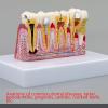 JYBNBBE Anatomical Tooth Decay Model for Anatomy and Physiology Education view 4